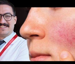 Gül Hastalığı Nedir? Belirtileri, Nedenleri ve Tedavisi