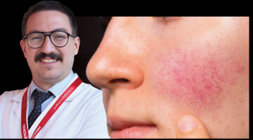 Gül Hastalığı Nedir? Belirtileri, Nedenleri ve Tedavisi