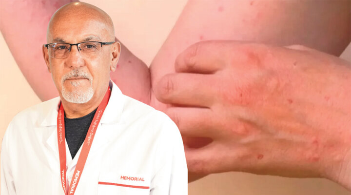 Sivrisinek Kaynaklı Chikungunya Virüsüne Karşı Uyarı